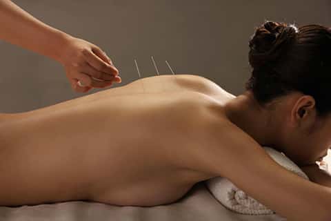 aiguilles acupuncture