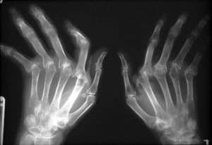 image - radio arthrose