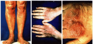 Image - maladie de Lyme - Lichen atrophique