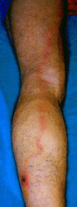 Image - maladie de Lyme - Lymphangite