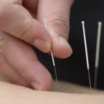 acupuncteur à lausanne