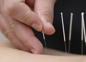 acupuncteur à lausanne