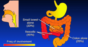 schéma de la maladie de crohn