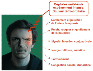 céphalée trigéminoautonomique cluster head
