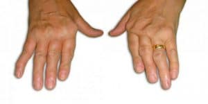 arthrite inflammation articulaire