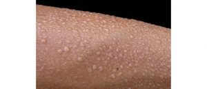 Transpiration excessive et homéopathie